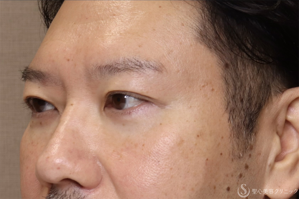 【40代男性・目の開きを改善】眼瞼下垂（腱膜縫縮法）（3ヶ月後） After 