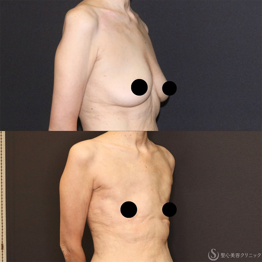 【60代女性・胸をスッキリと】ベイザー脂肪吸引（胸）＋乳腺切除（術後4ヶ月） After 