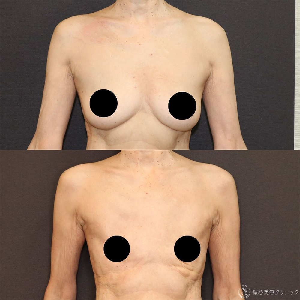 【60代女性・胸をスッキリと】ベイザー脂肪吸引（胸）＋乳腺切除（術後4ヶ月） After 