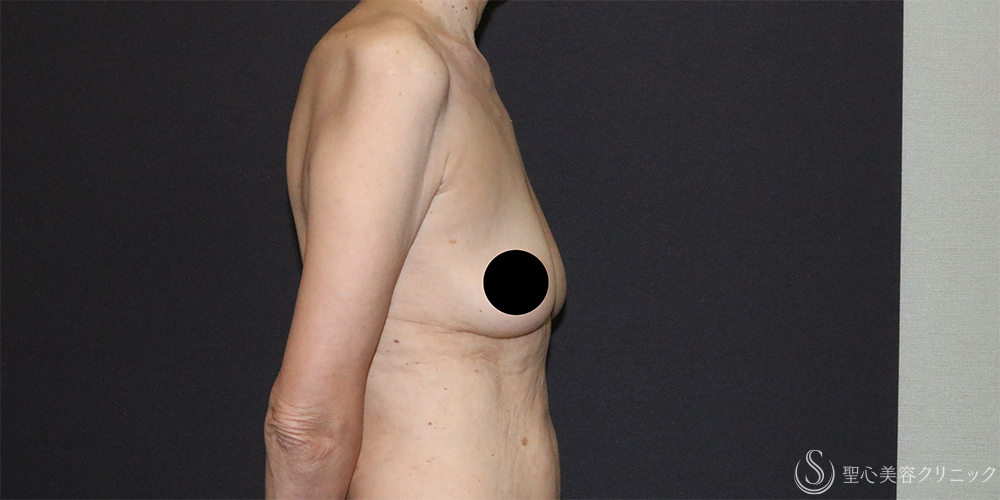 【60代女性・胸をスッキリと】ベイザー脂肪吸引（胸）＋乳腺切除（術後4ヶ月） Before 