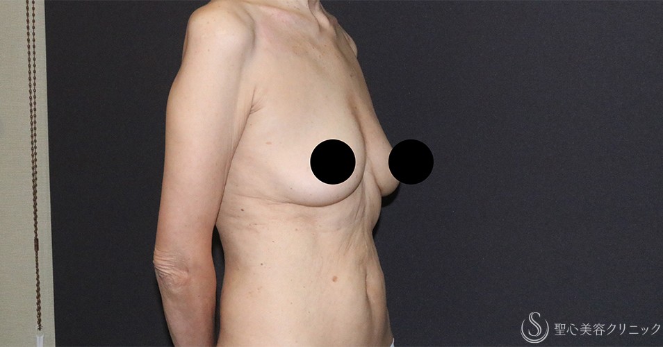 【60代女性・胸をスッキリと】ベイザー脂肪吸引（胸）＋乳腺切除（術後4ヶ月） Before 