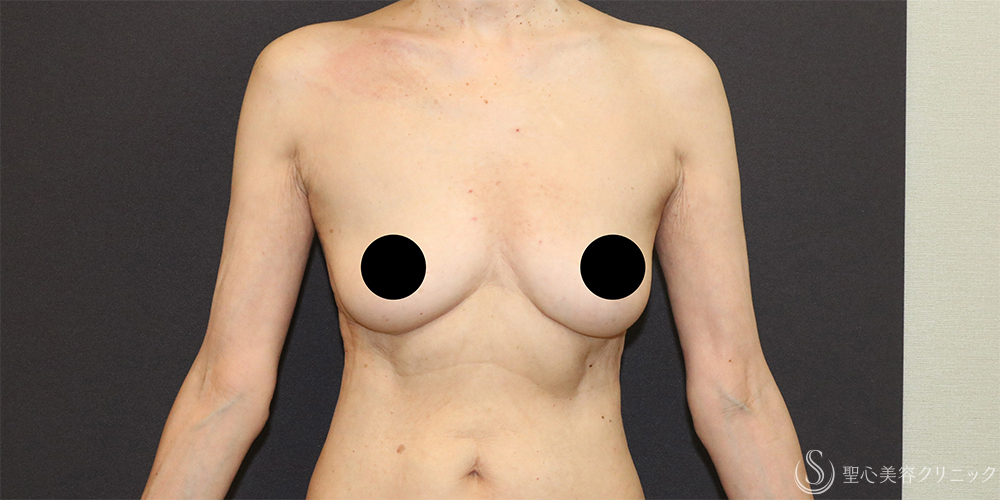 【60代女性・胸をスッキリと】ベイザー脂肪吸引（胸）＋乳腺切除（術後4ヶ月） Before 