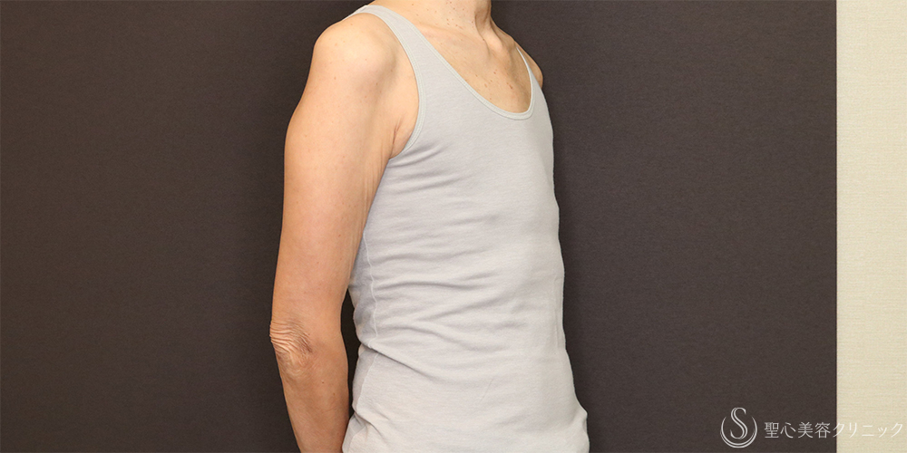 【60代女性・胸をスッキリと】ベイザー脂肪吸引（胸）＋乳腺切除（術後4ヶ月） After 