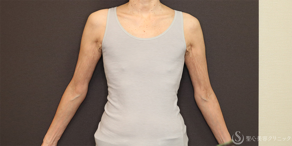 【60代女性・胸をスッキリと】ベイザー脂肪吸引（胸）＋乳腺切除（術後4ヶ月） After 