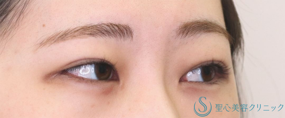 【20代女性・印象深い目元へ】二重術（切開法）部分切開/全切開（直後～1週間後） Before 
