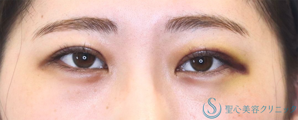 【20代女性・印象深い目元へ】二重術（切開法）部分切開/全切開（直後～1週間後） After 