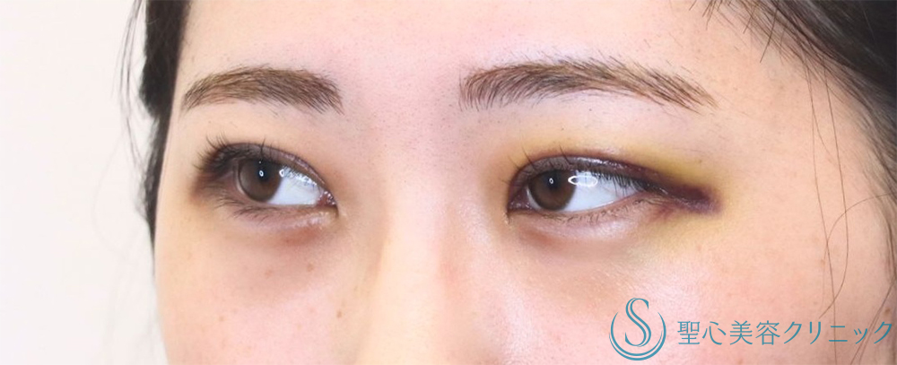 【20代女性・印象深い目元へ】二重術（切開法）部分切開/全切開（直後～1週間後） After 