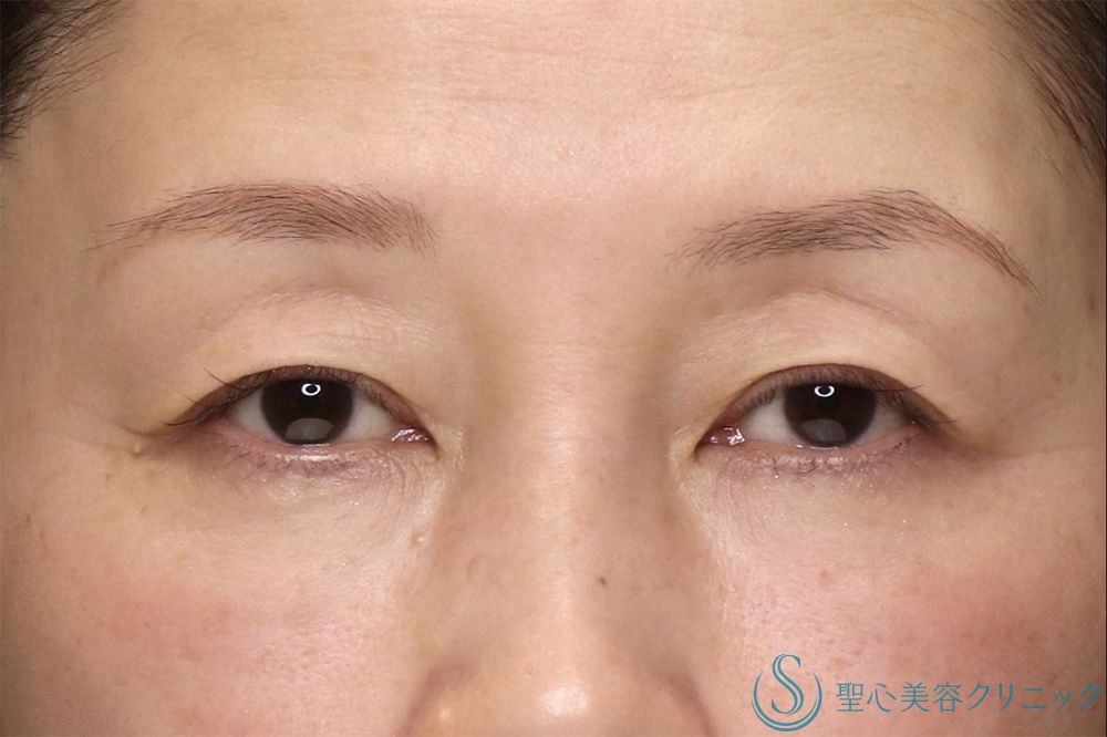 【50代女性・年齢とともに出る上瞼の重さを解消】眉下切開法（眉下リフト）（直後～1ヶ月後） Before 