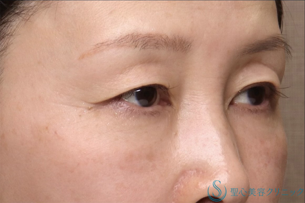 【50代女性・年齢とともに出る上瞼の重さを解消】眉下切開法（眉下リフト）（直後～1ヶ月後） Before 