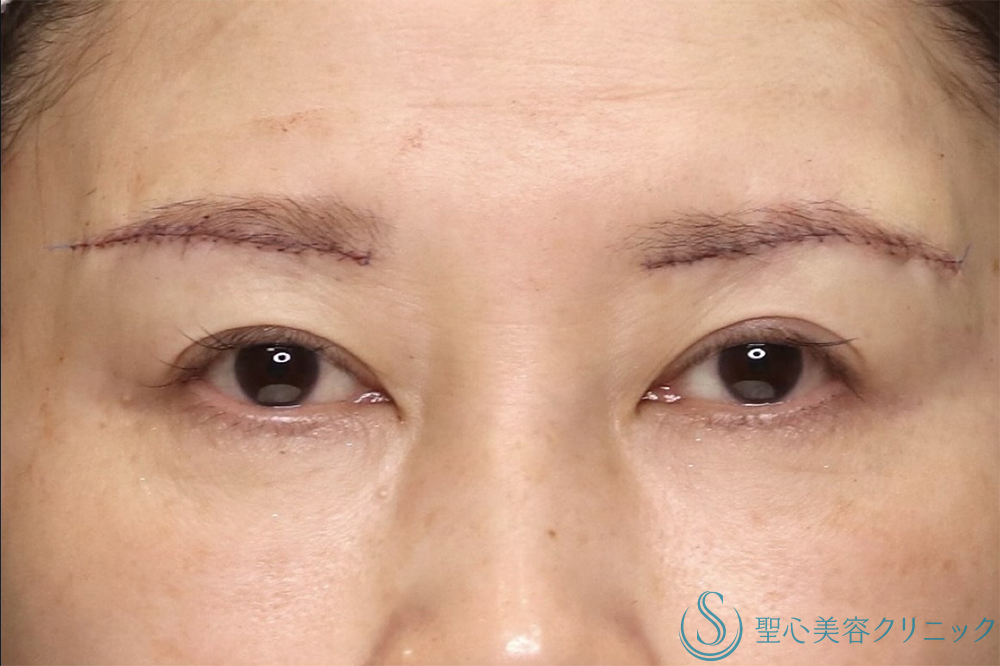 【50代女性・年齢とともに出る上瞼の重さを解消】眉下切開法（眉下リフト）（直後～1ヶ月後） After 