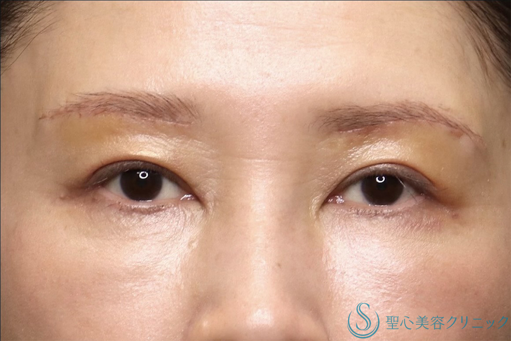 【50代女性・年齢とともに出る上瞼の重さを解消】眉下切開法（眉下リフト）（直後～1ヶ月後） After 