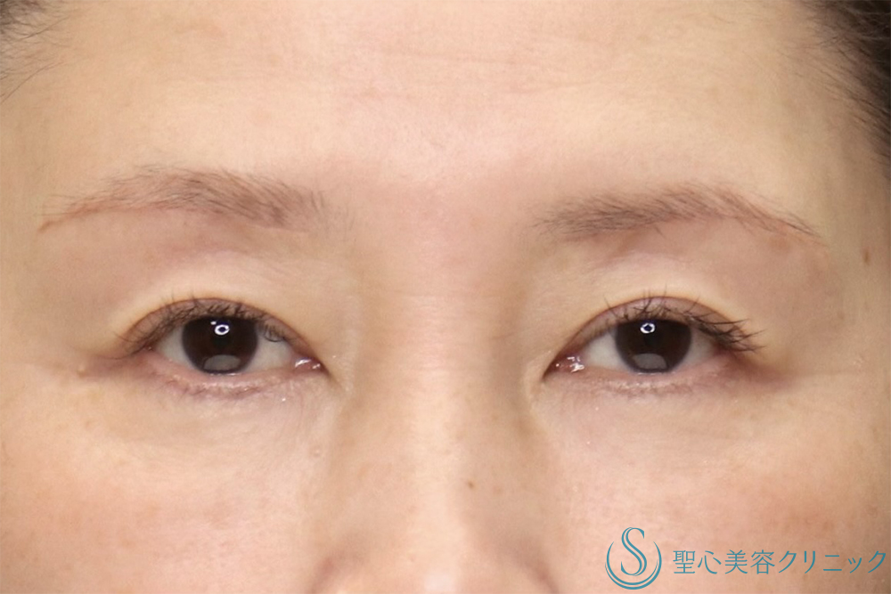 【50代女性・年齢とともに出る上瞼の重さを解消】眉下切開法（眉下リフト）（直後～1ヶ月後） After 