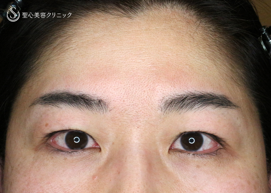 【49歳女性・重度のコンタクトレンズ眼瞼下垂】切らない眼瞼下垂+α法（術直後〜3ヶ月後） Before 