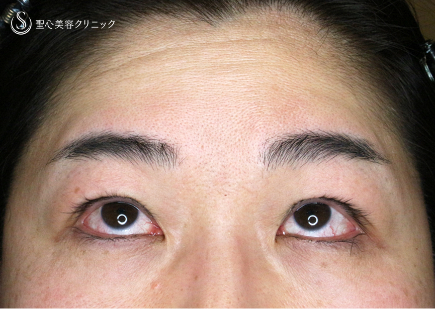 【49歳女性・重度のコンタクトレンズ眼瞼下垂】切らない眼瞼下垂+α法（術直後〜3ヶ月後） Before 