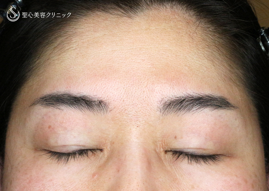 【49歳女性・重度のコンタクトレンズ眼瞼下垂】切らない眼瞼下垂+α法（術直後〜3ヶ月後） Before 
