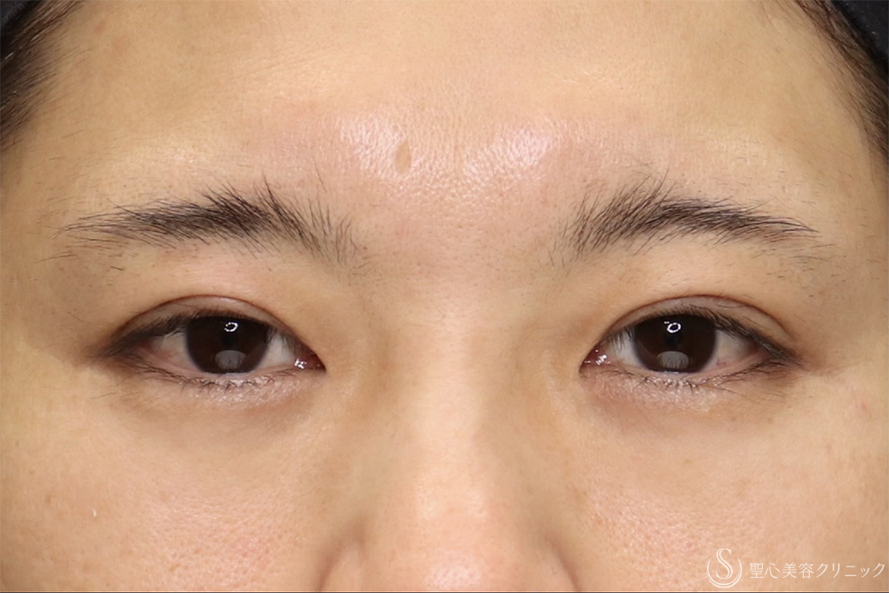 【40代男性・他院全切開修正で左右のバランスを整える】二重全切開（3ヶ月後） After 