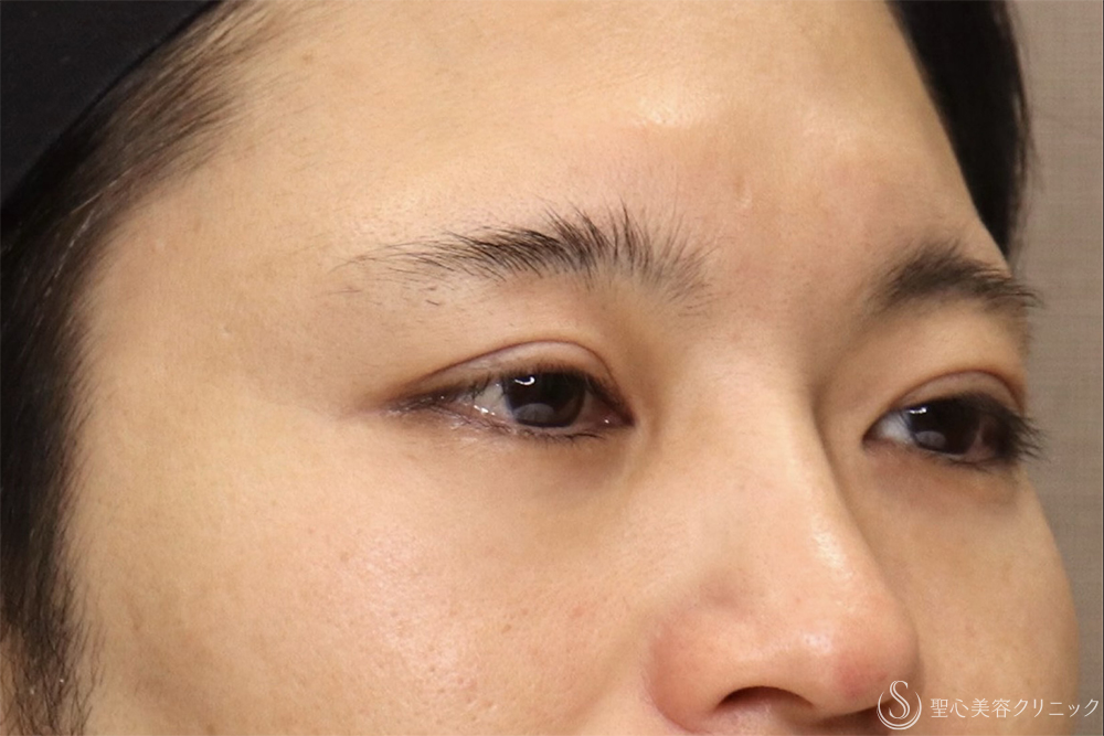 【40代男性・他院全切開修正で左右のバランスを整える】二重全切開（3ヶ月後） After 
