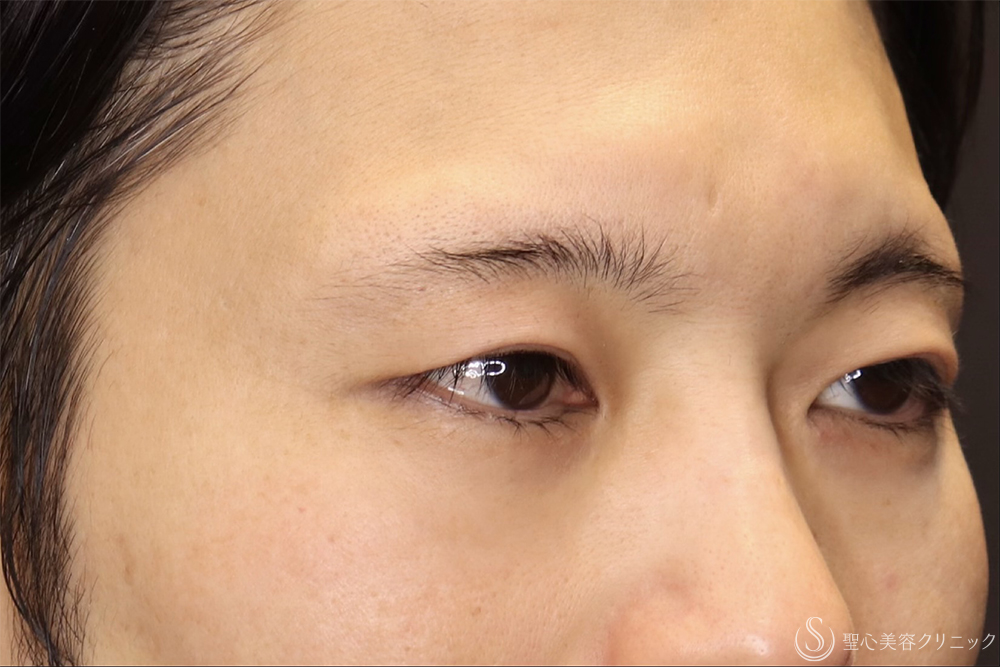 【40代男性・他院全切開修正で左右のバランスを整える】二重全切開（3ヶ月後） Before 