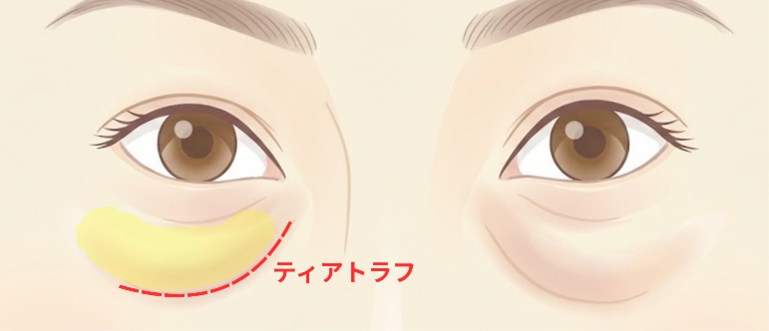 若いうちから気になる場合は、くぼみ型のたるみの可能性があります