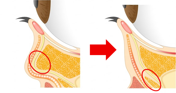 裏ハムラ法（経結膜前眼窩脂肪移動術）で目の下のたるみを改善