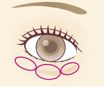 「黒クマ」が気になる場合は、ふくらみ型のたるみの可能性があります