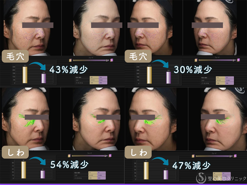 【40代女性・毛穴やしわを同時に改善】ドクターDENSITY（デンシティ）（2ヶ月後） After 