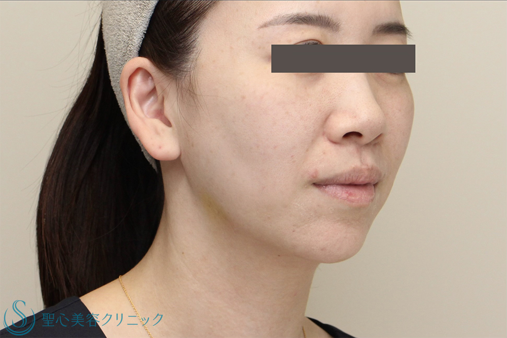 【30代女性・フェイスライン・口元のたるみ】DENSITY＋広頚筋ボトックス（ボトックスリフト）（2週間後） After 