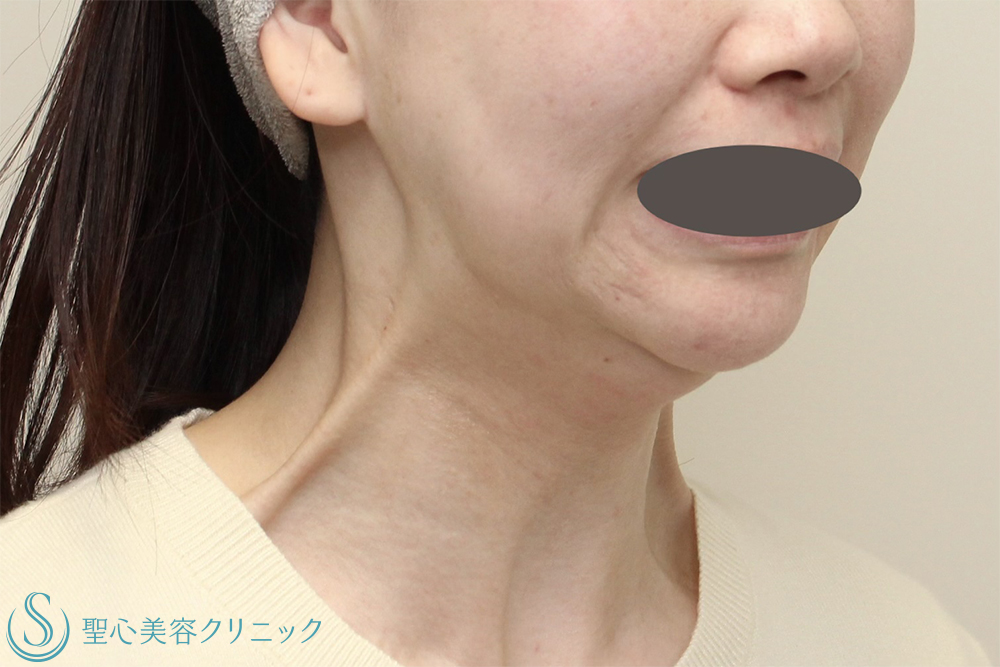 【30代女性・フェイスライン・口元のたるみ】DENSITY＋広頚筋ボトックス（ボトックスリフト）（2週間後） Before 