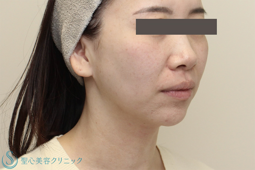 【30代女性・フェイスライン・口元のたるみ】DENSITY＋広頚筋ボトックス（ボトックスリフト）（2週間後） Before 