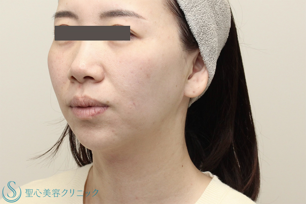 【30代女性・フェイスライン・口元のたるみ】DENSITY＋広頚筋ボトックス（ボトックスリフト）（2週間後） Before 