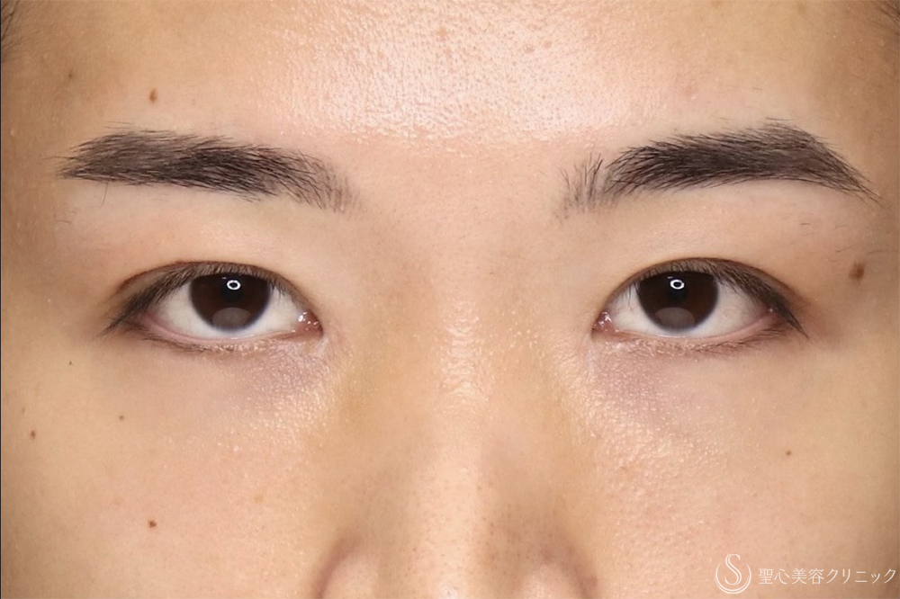 【20代男性・左右差を整えて端正な目元に】二重術全切開（1ヶ月後） After 