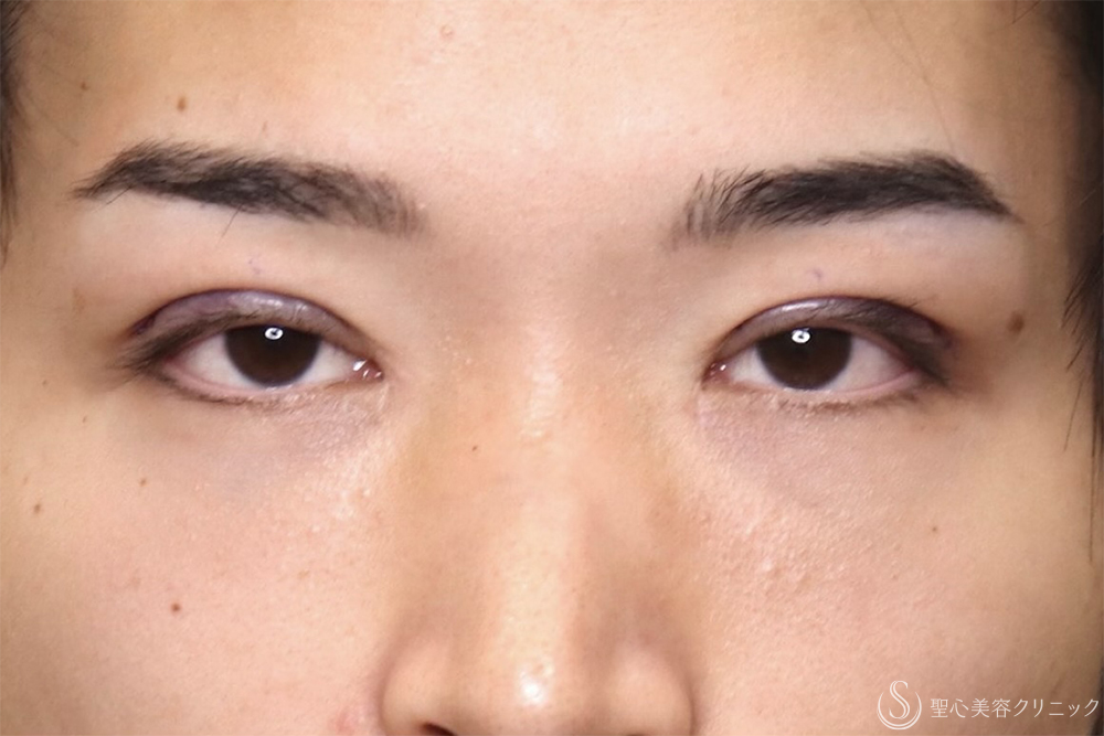【20代男性・左右差を整えて端正な目元に】二重術全切開（1ヶ月後） After 
