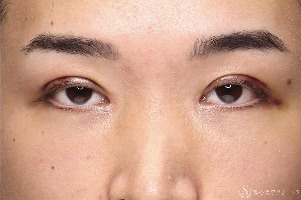 【20代男性・左右差を整えて端正な目元に】二重術全切開（1ヶ月後） After 