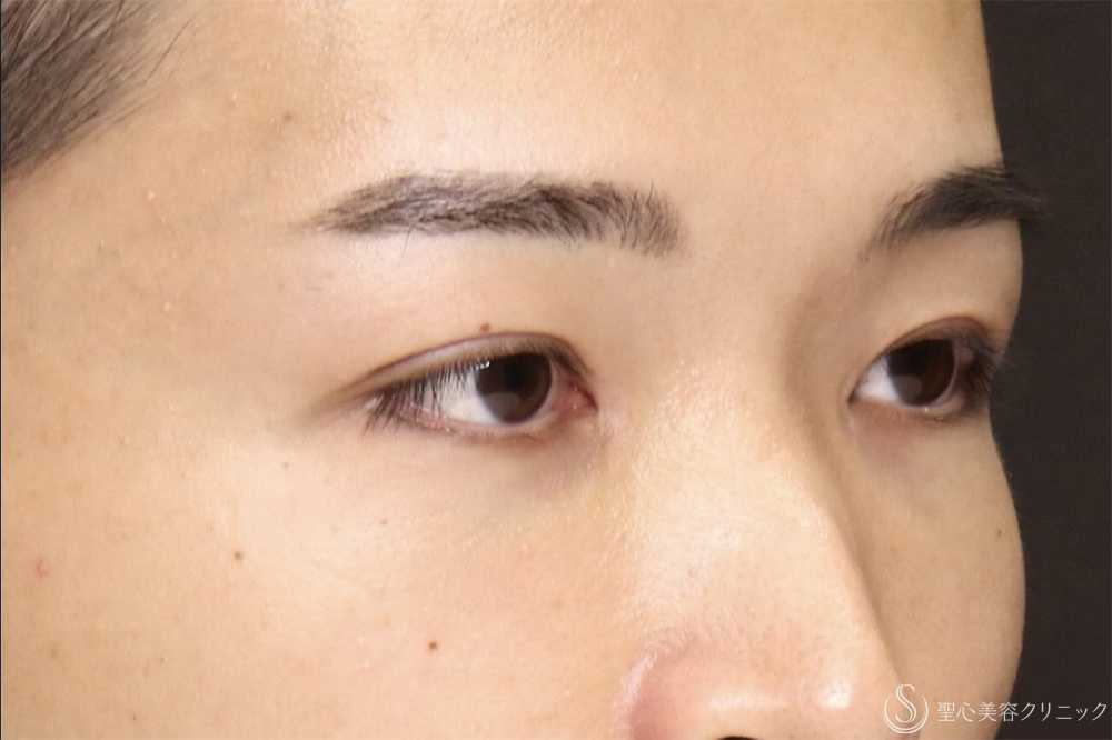 【20代男性・左右差を整えて端正な目元に】二重術全切開（1ヶ月後） After 