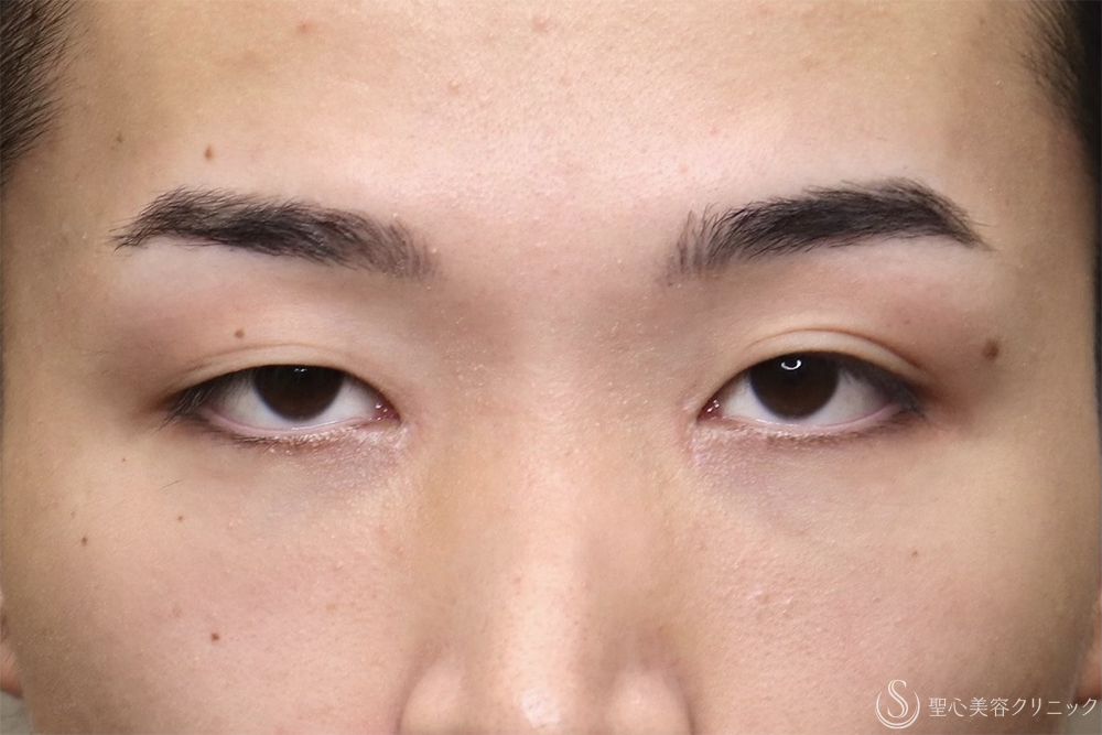 【20代男性・左右差を整えて端正な目元に】二重術全切開（1ヶ月後） Before 
