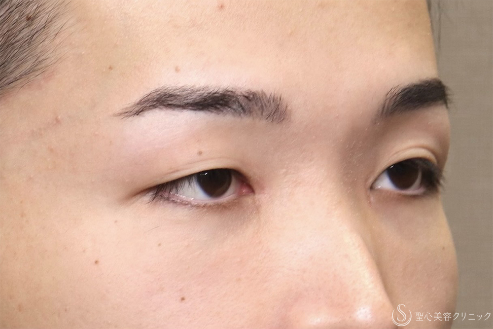 【20代男性・左右差を整えて端正な目元に】二重術全切開（1ヶ月後） Before 