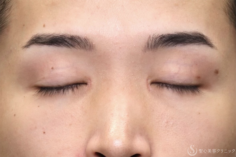 【20代男性・左右差を整えて端正な目元に】二重術全切開（1ヶ月後） Before 