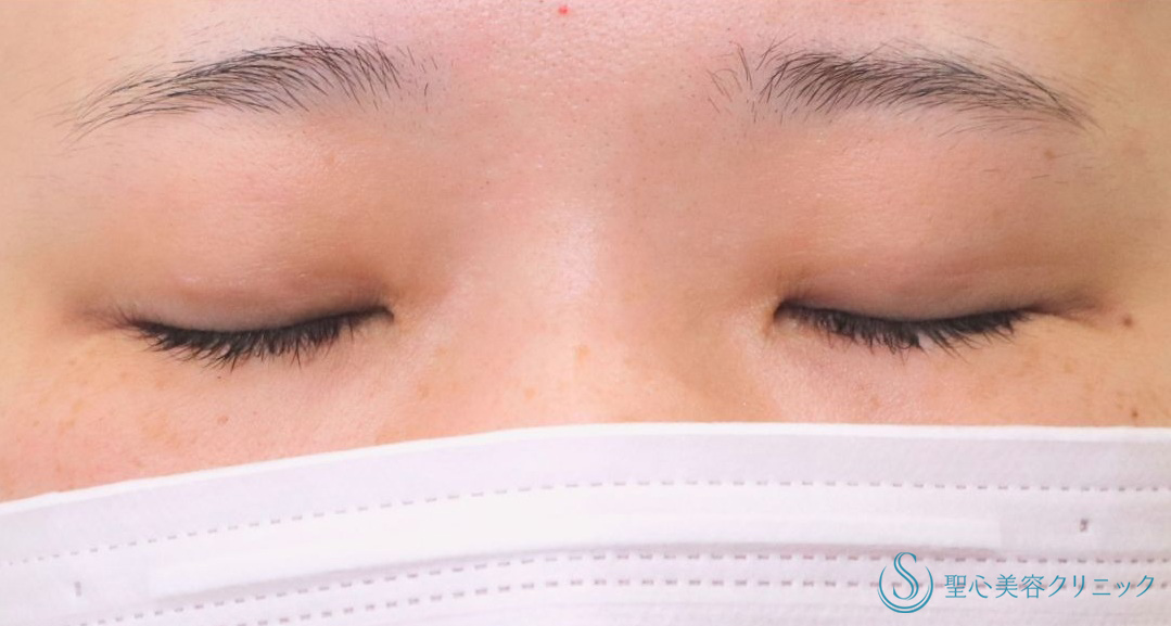 【30代女性・自然にクッキリした二重に】二重術（埋没法）：マイクロメソッド+α（1ヶ月後） After 