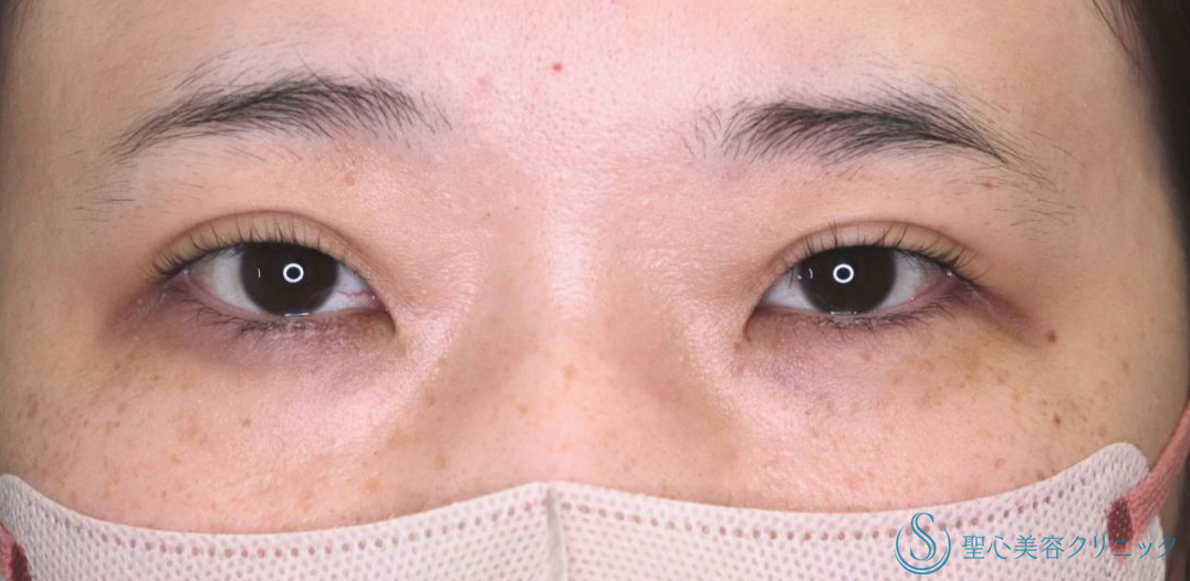 【30代女性・自然にクッキリした二重に】二重術（埋没法）：マイクロメソッド+α（1ヶ月後） Before 