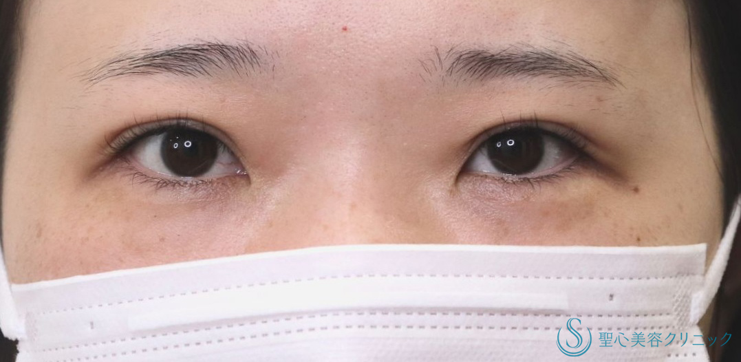 【30代女性・自然にクッキリした二重に】二重術（埋没法）：マイクロメソッド+α（1ヶ月後） After 