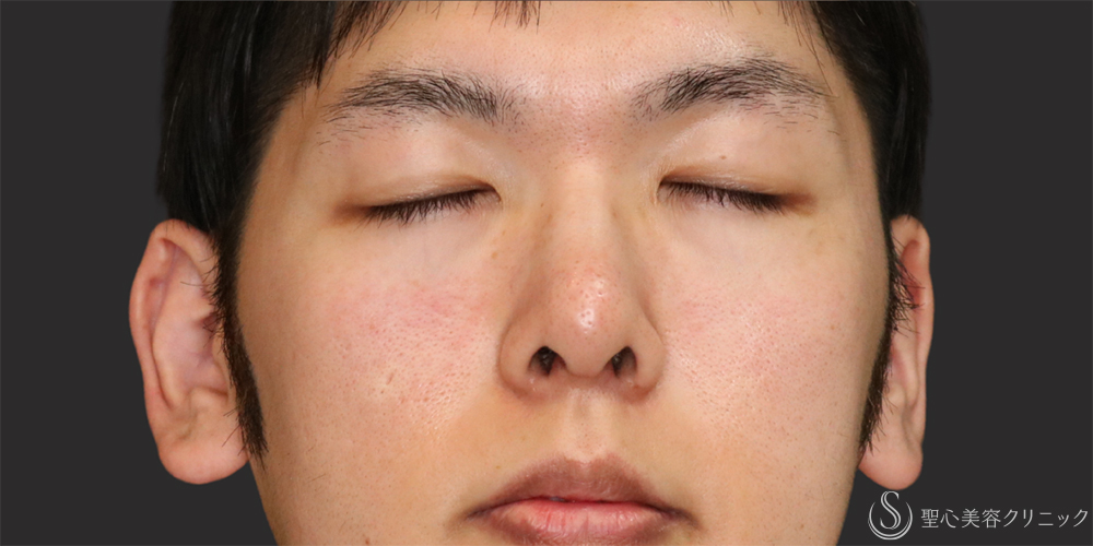 【20代男性・アップノーズを改善】鼻尖縮小（ストラット法）＋鼻尖形成（耳介軟骨移植）（1ヶ月後） After 
