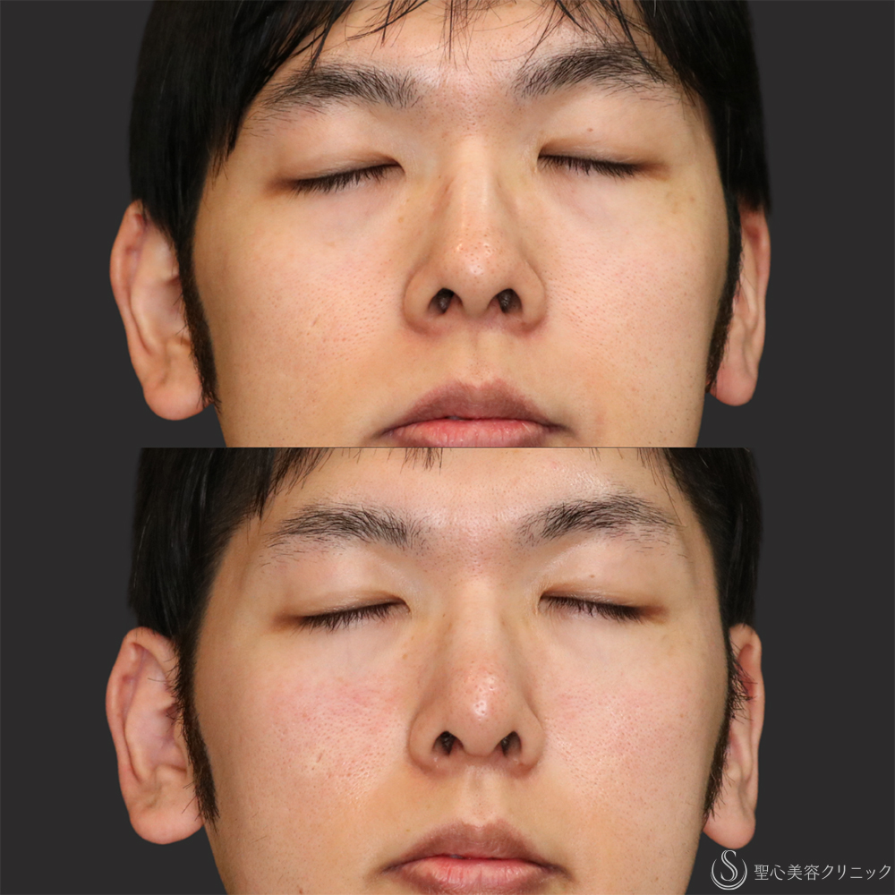 【20代男性・アップノーズを改善】鼻尖縮小（ストラット法）＋鼻尖形成（耳介軟骨移植）（1ヶ月後） After 名古屋・鼻フル・鼻尖形成