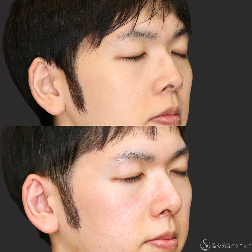 【20代男性・アップノーズを改善】鼻尖縮小（ストラット法）＋鼻尖形成（耳介軟骨移植）（1ヶ月後） After 名古屋・鼻フル・鼻尖形成