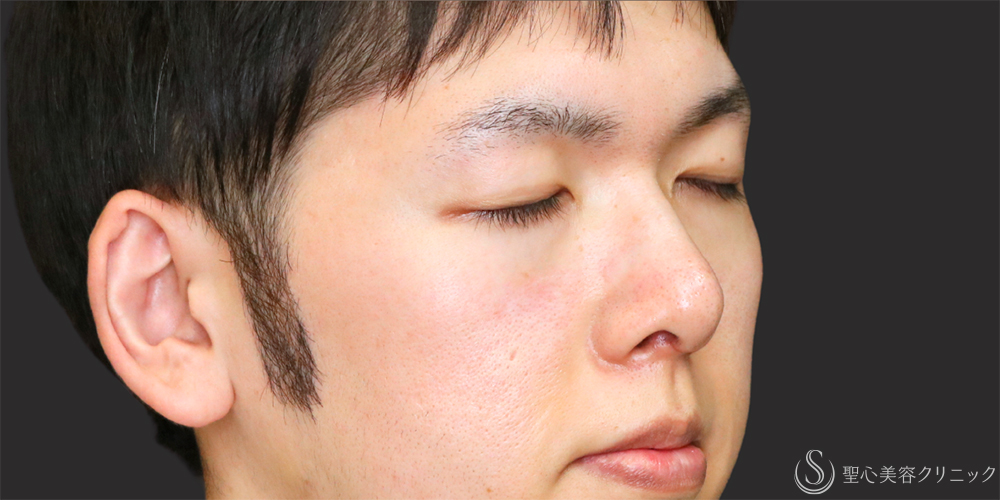【20代男性・アップノーズを改善】鼻尖縮小（ストラット法）＋鼻尖形成（耳介軟骨移植）（1ヶ月後） After 