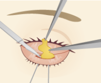 脂肪取り（経結膜下脱脂法）で目の下のたるみを改善