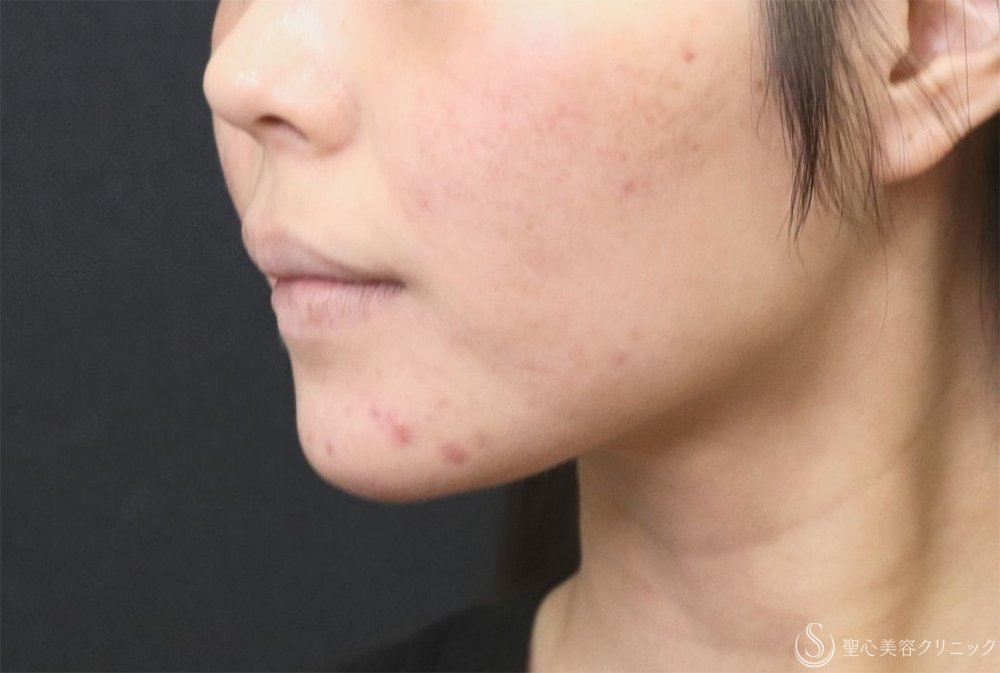 【20代女性・フェイスラインスッキリ】脂肪吸引注射（頬・顎下）（半年後） Before 