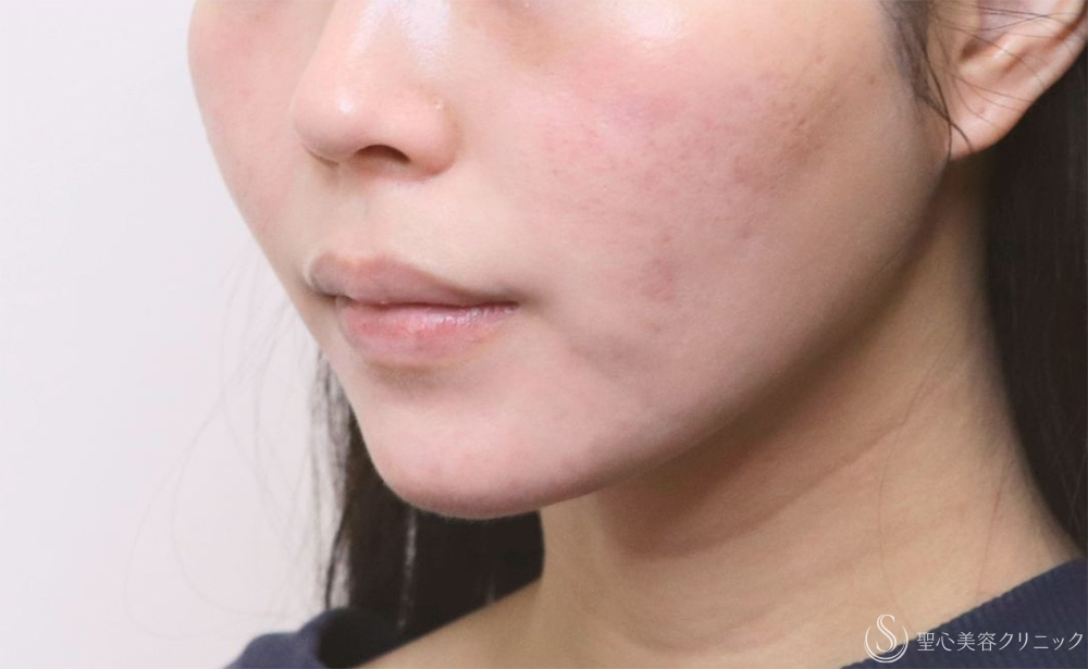 【20代女性・フェイスラインスッキリ】脂肪吸引注射（頬・顎下）（半年後） After 