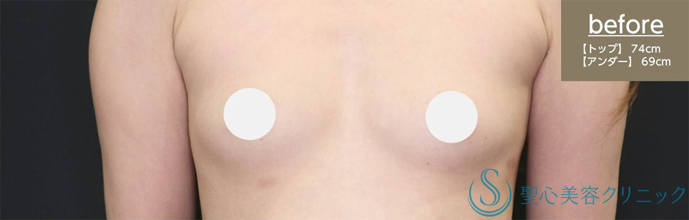 【30代女性・しっかりとしたバストアップ】プレミアムピュアグラフト豊胸術（2回後）（術後3ヶ月） Before 