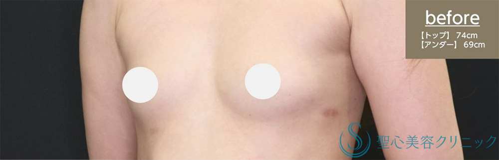 【30代女性・しっかりとしたバストアップ】プレミアムピュアグラフト豊胸術（2回後）（術後3ヶ月） Before 