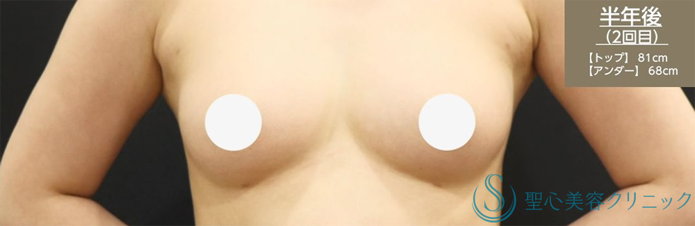 【30代女性・しっかりとしたバストアップ】プレミアムピュアグラフト豊胸術（2回後）（術後3ヶ月） After 